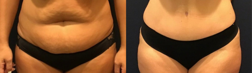 before and after tummy tuck front view of female patient