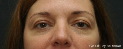 Before eyelid surgery front view female patient case 2792