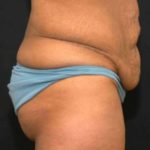 Before tummy tuck right side view female patient case 2764