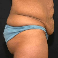 Before tummy tuck right side view female patient case 2764