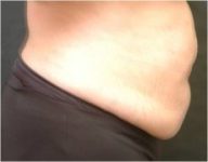 Before tummy tuck side view female patient case 2769