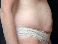 Before tummy tuck right side view female patient case 2808