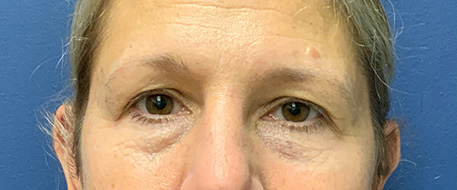 before eyelid surgery front view female patient case 4633