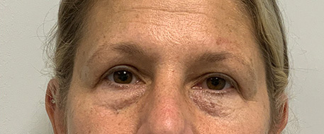 after eyelid surgery front view female patient case 4633