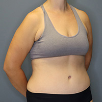 after tummy tuck right angle view female patient case 4946