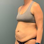 before tummy tuck left angle view female patient case 4946