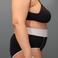 after tummy tuck right side view female patient case 5220
