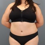 after tummy tuck front view female patient case 5356